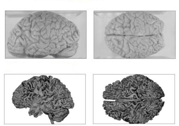 The brain of a healthy person (above) and the brain of an alcoholic with irreversible consequences (below)