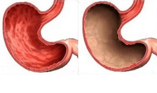 Ulcer, gastritis, cancer and other pathologies of the stomach (right), the appearance of which is caused by alcohol